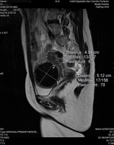 Radiologia Interventistica - Fibroma uterino - caso clinico 2013 - figura 10