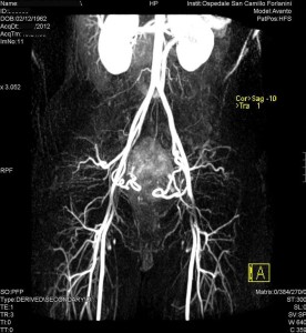 Radiologia Interventistica - Fibroma uterino - caso clinico 2013 - figura 2