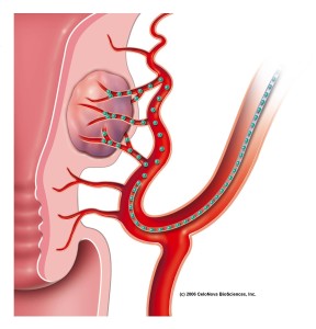radiologia interventistica-embolizzazione-fibroma uterino-arrivo particelle