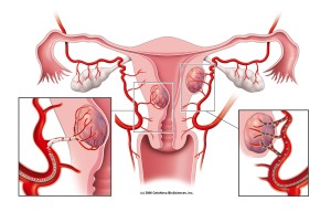 radiologia interventistica-embolizzazione-fibroma uterino-confronto sferiche e non sferiche