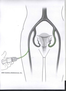 radiologia interventistica-embolizzazione-fibroma uterino-iniezione embolizzante