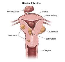 radiologia interventistica-fibroma uterino-fibromi-uterini