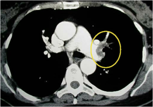 Fig . 1 - Computed tomography of the chest with pulmonary embolism on the left 