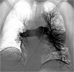 FIG. 3 - Selective catheterization of the left  pulmonary artery from transfemoral approach 