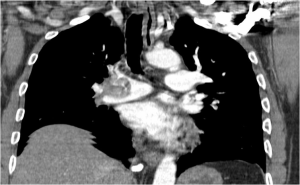FIG. 5 - TC of the lungs with massive pulmonary embolism in the right pulmonary artery.