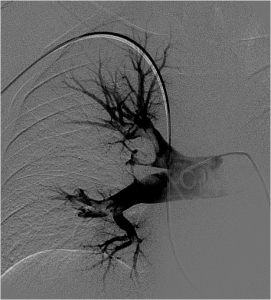FIG. 6 - Selective angiography after the first passage  of the rotating motion: the big  embolus was fragmented into three prts.