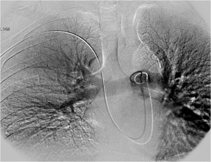 FIG. 7 - Global  pulmonary angiography after three days of therapy.
