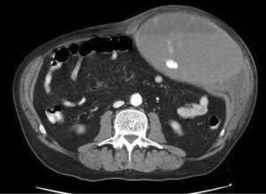 CT large left-sided rectus muscle hematoma