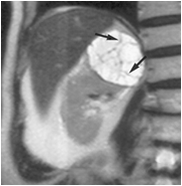 radiografie tumori renali