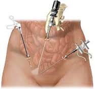 Tecnica laparoscopica