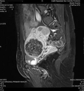 Radiologia Interventistica - Fibroma uterino - caso clinico 2013 - figura 1