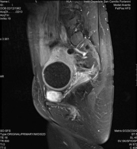 Radiologia Interventistica - Fibroma uterino - caso clinico 2013 - figura 9