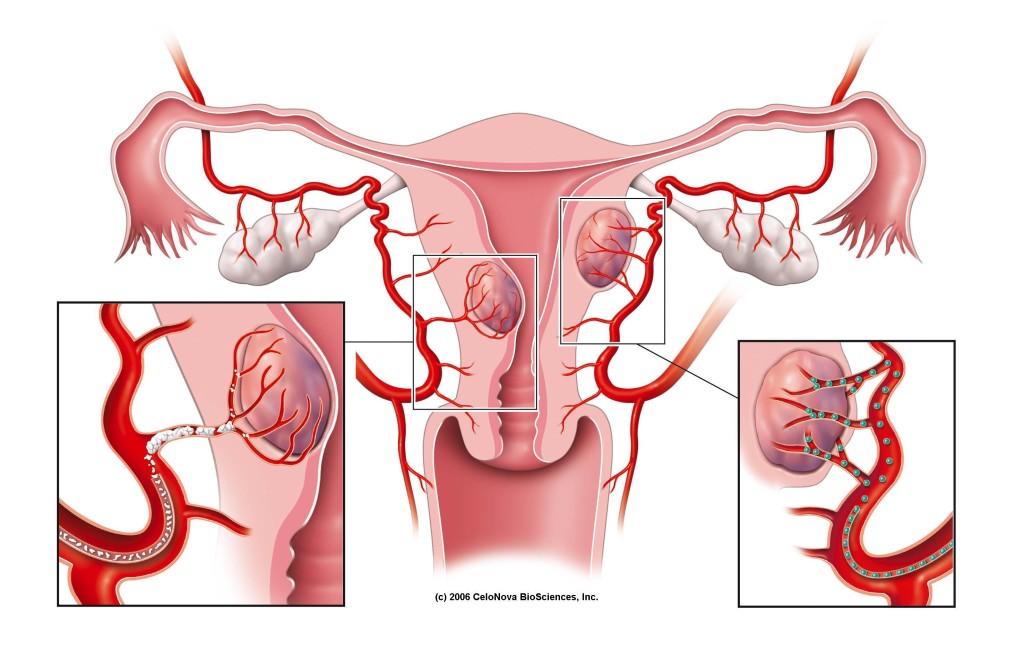 radiologia interventistica-embolizzazione-fibroma uterino-confronto sferiche e non sferiche