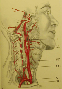 carotid artery stenting cas disegno