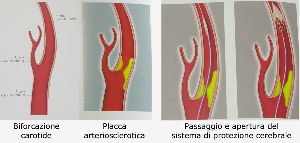 passaggio presidi stenosi