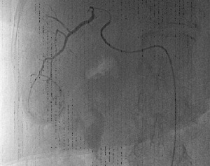 Cateterismo superselettivo dell’arteria epatica destra