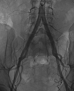 fibroma uterino caso clinico arteriografia panoramica