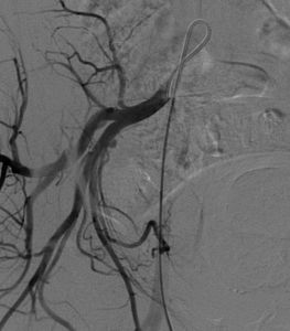 fibroma uterino caso clinico arteriografia selettiva destra