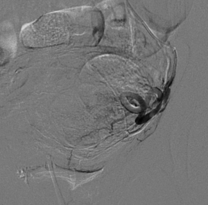 fibroma uterino caso clinico arteriografia selettiva sinistra