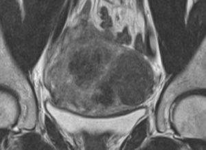 fibroma uterino caso clinico risonanza magnetica