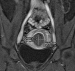 fibroma uterino caso clinico risonanza magnetica a 6 mesi