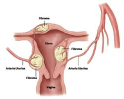 Fibroma uterino