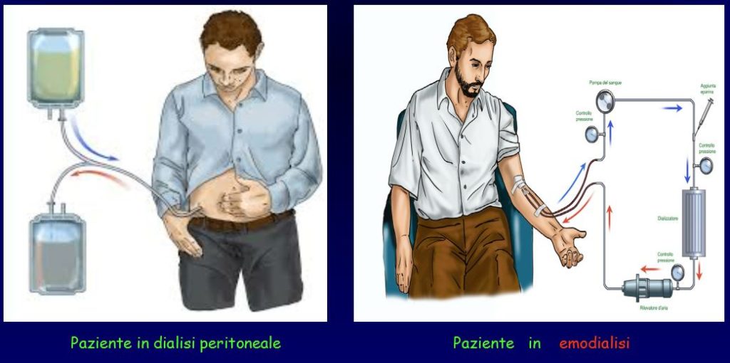 paziente in dialisi peritoneale e paziente in emodialisi